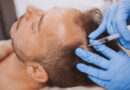 Jak skutecznie leczyć łysienie plackowate?